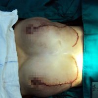 海南16歲＂巨乳癥＂少女手術治療成功 10天后拆線