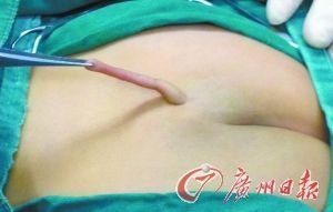 女嬰屁股上長尾巴