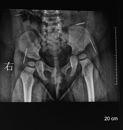 女嬰體內4根繡花針