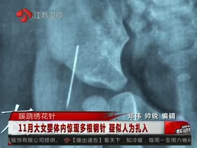 女嬰體內4根繡花針