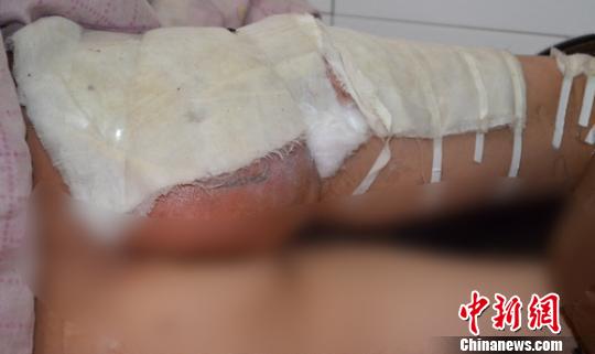 孩子咳嗽沒錢治病 土方法草藥熏蒸致嚴重燙傷