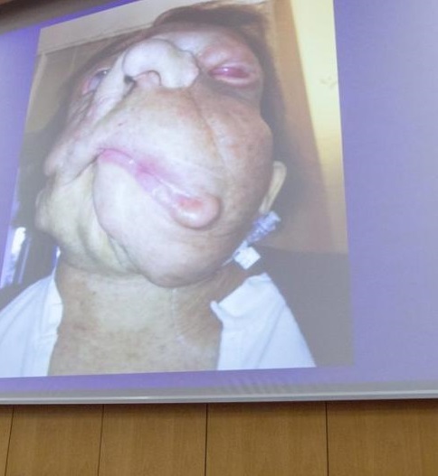 波蘭換臉手術成功案例 26歲女子成功換臉