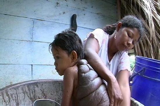 男孩背上長烏龜殼受嘲笑 烏龜殼男孩圖片