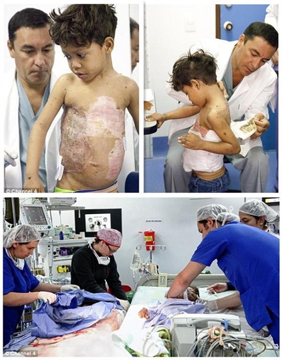 男孩背上長烏龜殼受嘲笑 烏龜殼男孩圖片