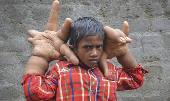 八歲男童長巨手