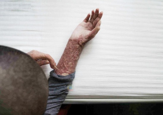 遭官二代毀容少女周巖