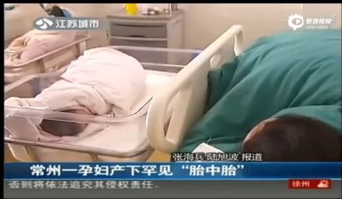 孕婦產下胎中胎