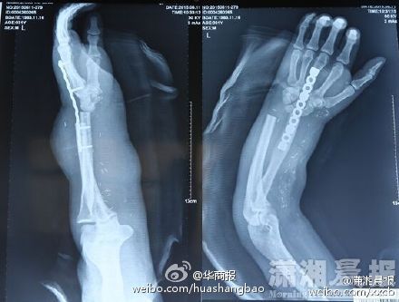 斷手寄養在小腿