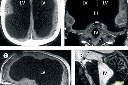 男子大腦消失過半