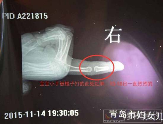 李滄區大蘋果幼兒園老師毆打幼童