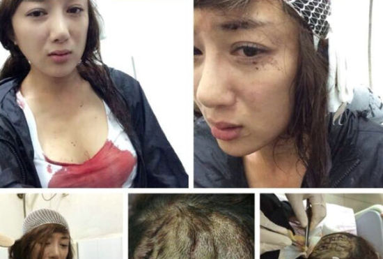 李依曉受傷資料圖