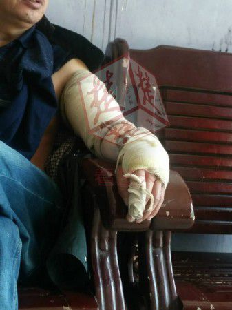 被砍下蛇頭咬男子