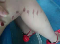 短裙女孩遭潑液體灼傷 福州警方介入調(diào)查