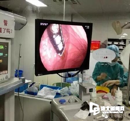 10歲女孩誤吞電池