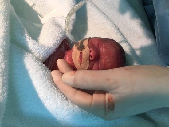 巴掌大小雙胞胎