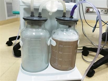 肺有3000毫升泥漿