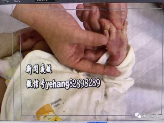 女嬰先天皮膚缺失