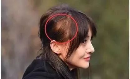 脫發更長壽上熱搜