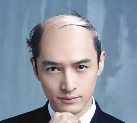 脫發更長壽上熱搜