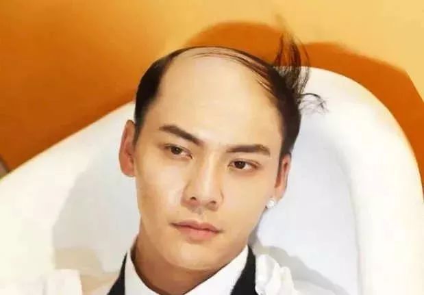 脫發更長壽上熱搜