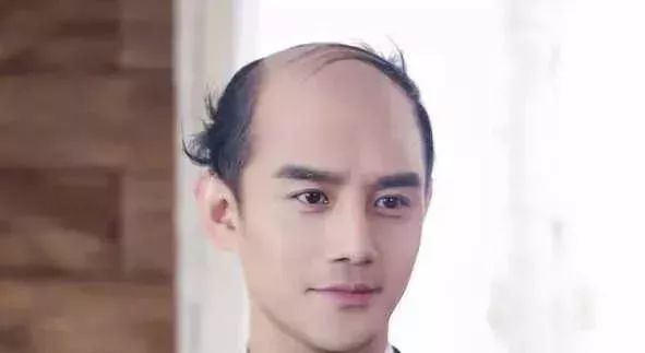 脫發更長壽上熱搜