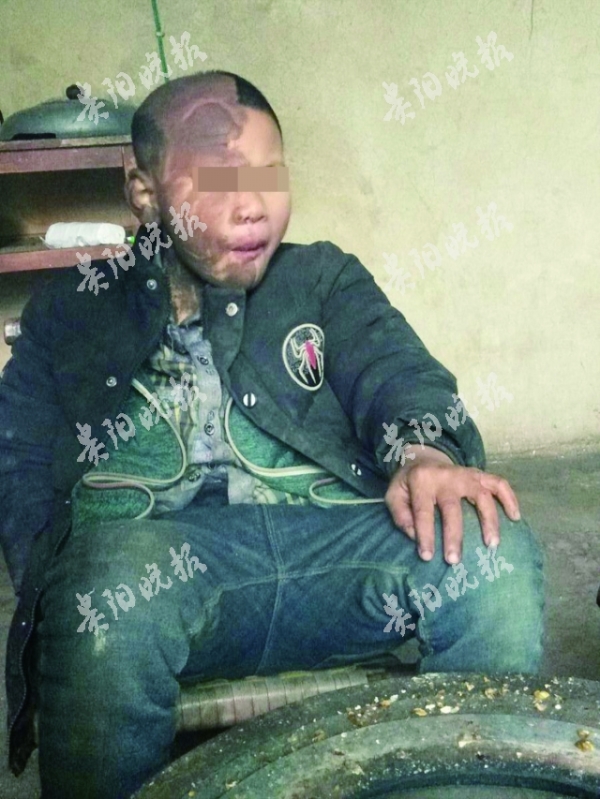 男孩身體半黑半白