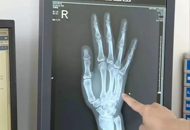 看世界杯把手拍斷骨折