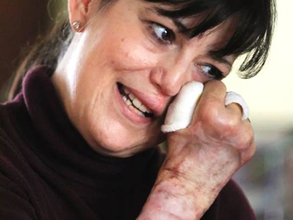 被愛犬舔舐后截肢