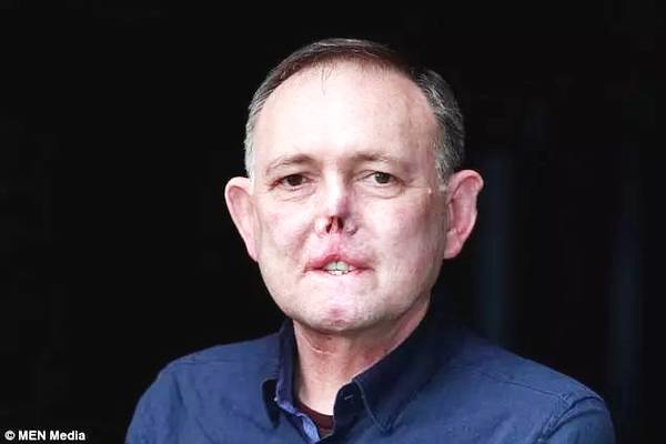 被愛犬舔舐后截肢