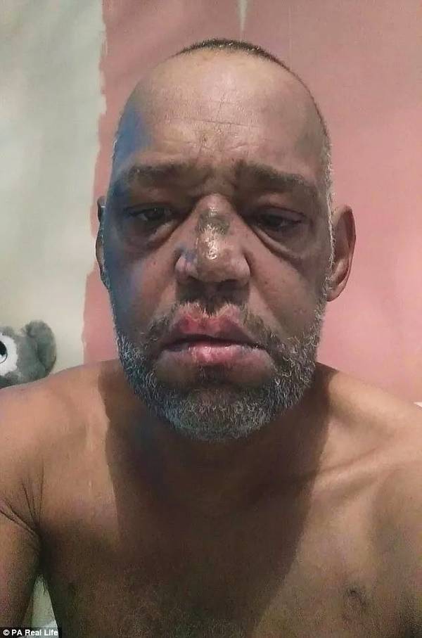 被愛犬舔舐后截肢