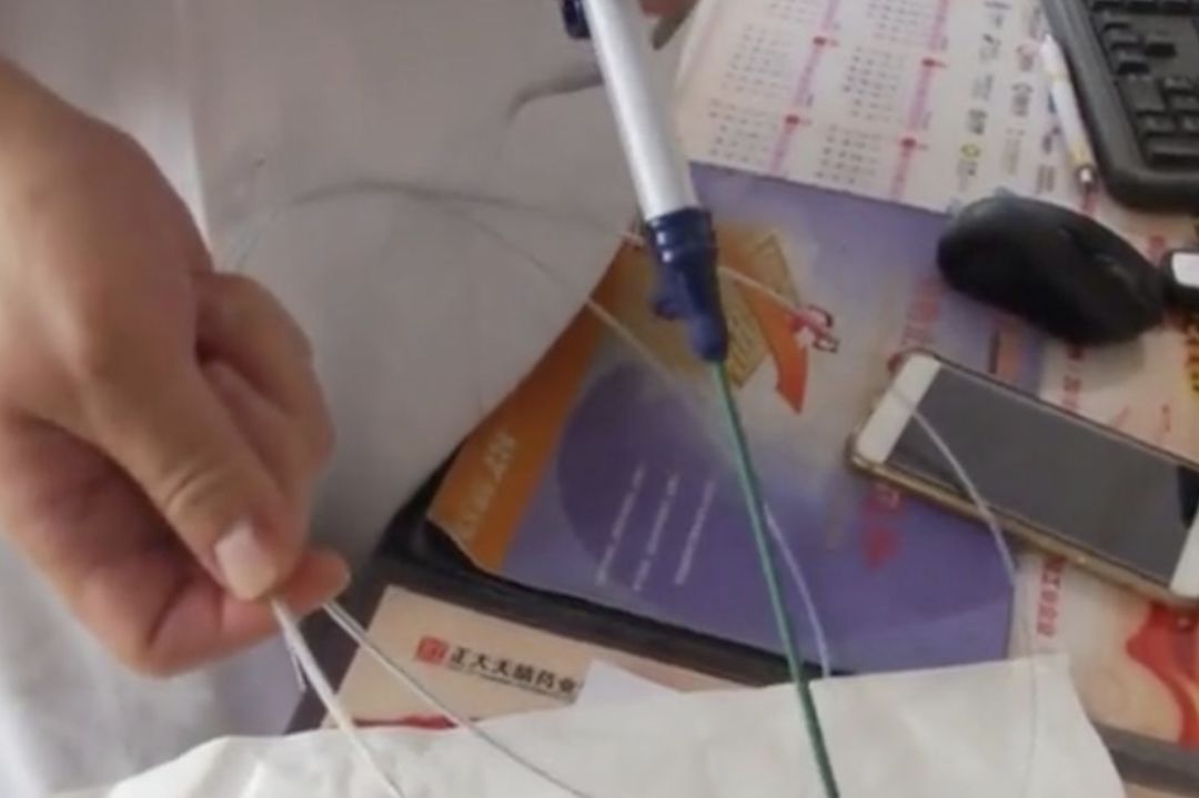 女孩醉酒吞下湯勺