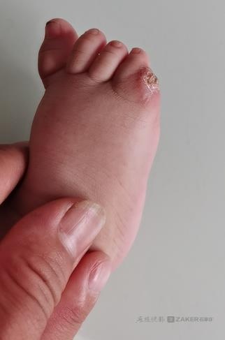 醫生給幼兒小腳趾手術失誤致截肢