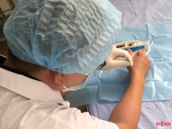 四川骨科大夫左手給右手做手術(shù)